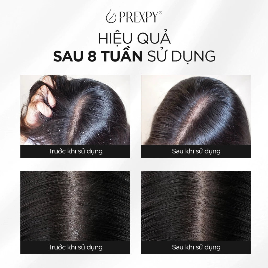 Serum sạch gàu 7ml